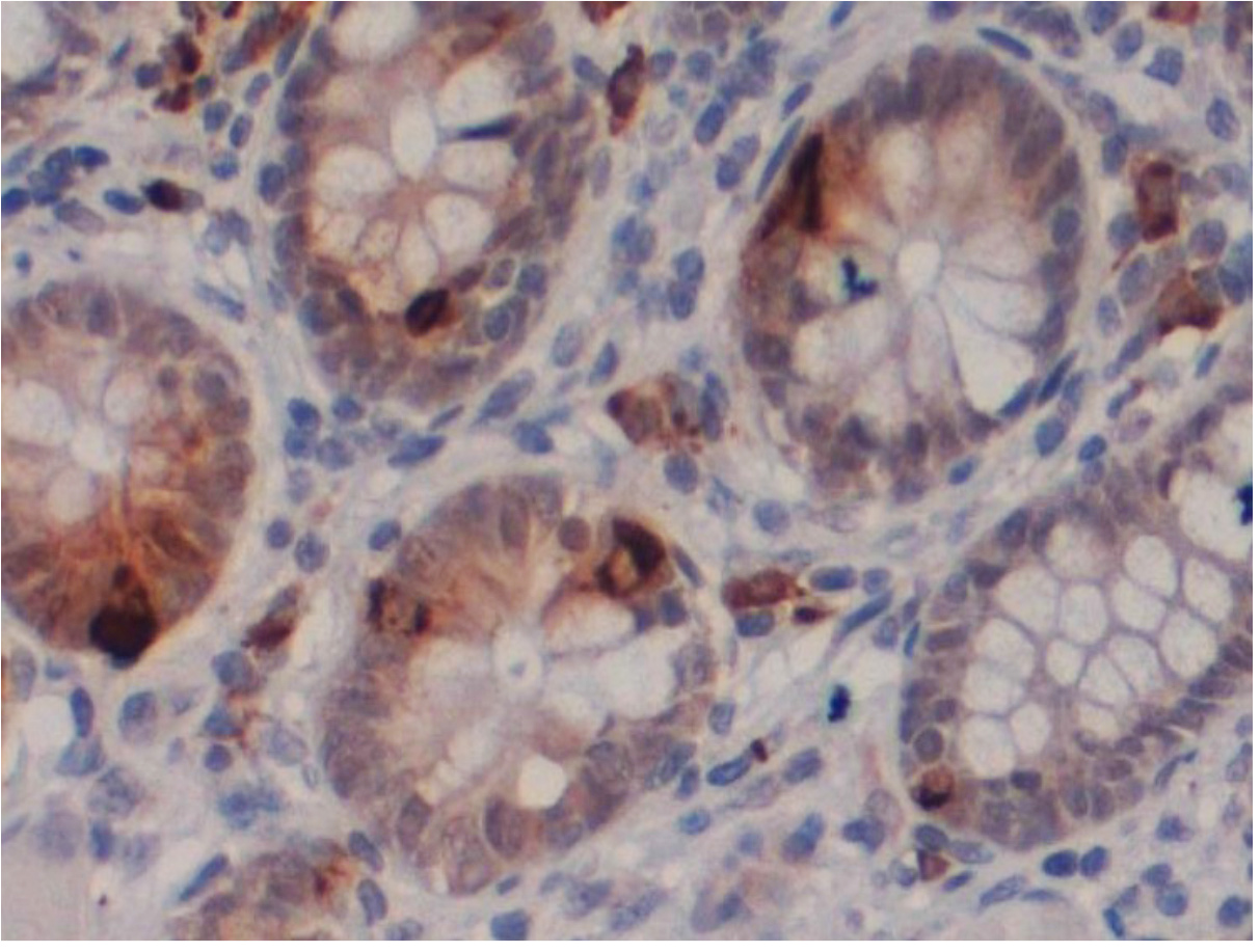"Immunohistochemical staining of human small bowel tissue using Chromogranin A antibody (Cat. No. X2789P).  Antibody used at 1 µg/ml.  4.
Pathologists comments: Staining in endocrine cells within the crypts."